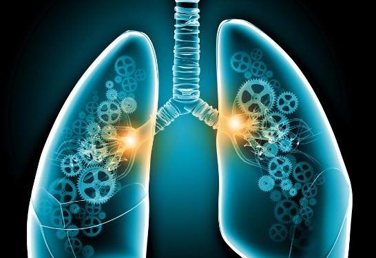 Oren Zarif – Treatments For lung cancer