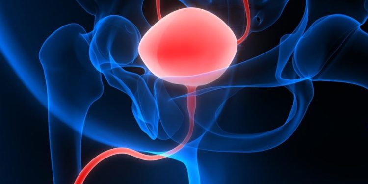 Oren Zarif – Treatments For Prostate Cancer